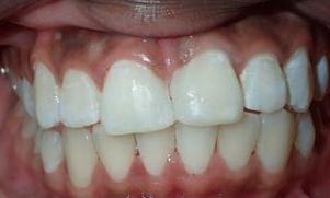 Bonding-Gap-Closure-After-Image