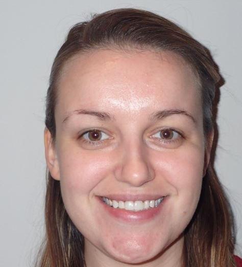 Zirconia-crowns-Bonding-Whitening-After-Image