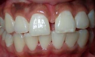 Bonding-Gap-Closure-Before-Image