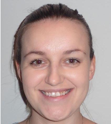 Zirconia-crowns-Bonding-Whitening-Before-Image